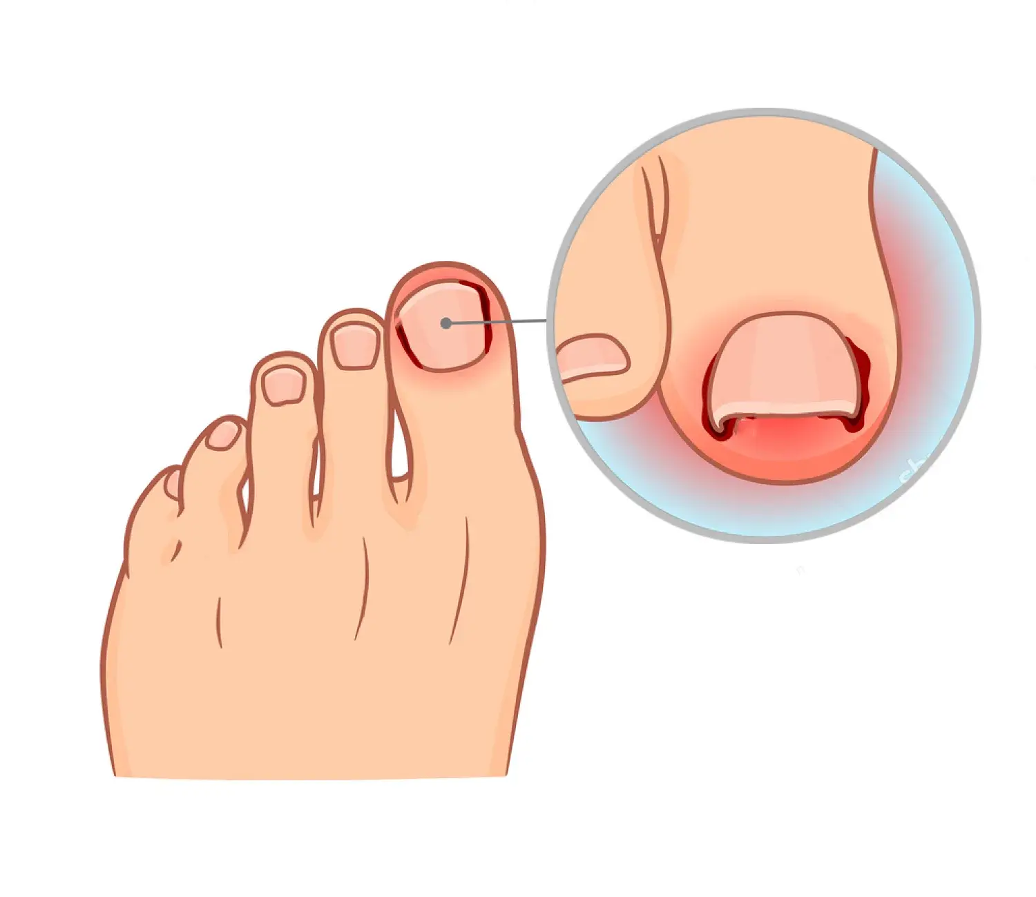 Illustration ongle incarné
